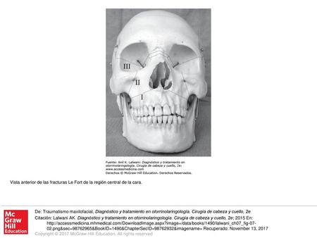 Vista anterior de las fracturas Le Fort de la región central de la cara. De: Traumatismo maxilofacial, Diagnóstico y tratamiento en otorrinolaringología.