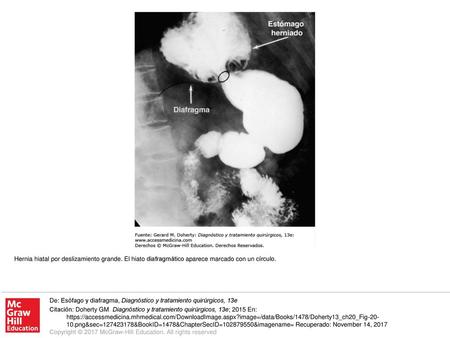 Hernia hiatal por deslizamiento grande