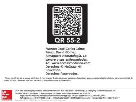 Partes en el frotis de la sangre periférica: A, muy grueso