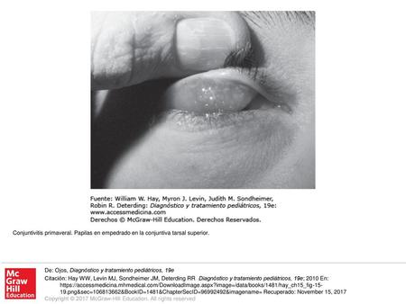 Conjuntivitis primaveral