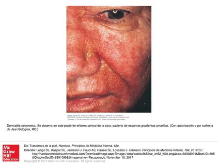 Dermatitis seborreica