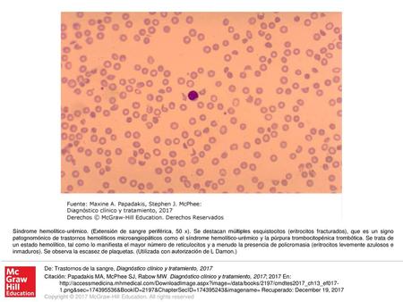 Síndrome hemolítico-urémico. (Extensión de sangre periférica, 50 x)