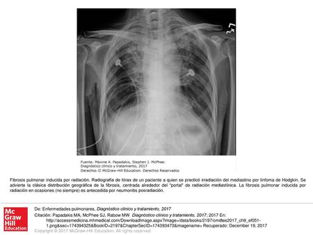 Fibrosis pulmonar inducida por radiación