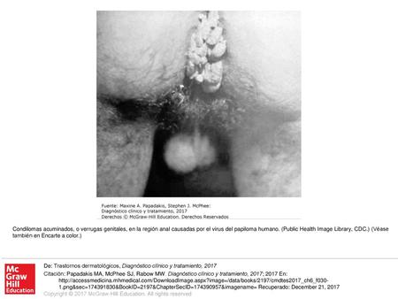 Condilomas acuminados, o verrugas genitales, en la región anal causadas por el virus del papiloma humano. (Public Health Image Library, CDC.) (Véase también.