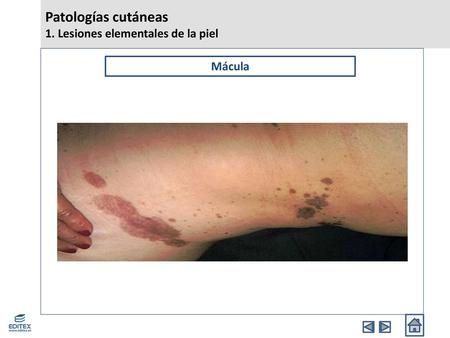 Patologías cutáneas 1. Lesiones elementales de la piel