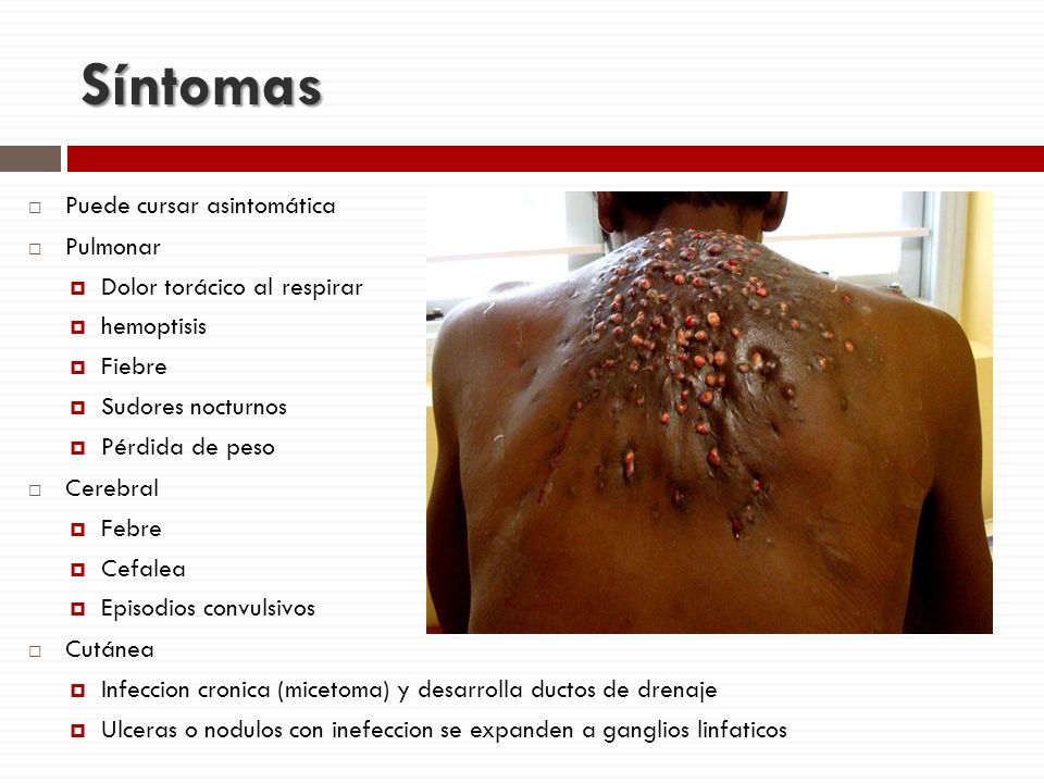 Síntomas Puede cursar asintomática Pulmonar Dolor torácico al respirar