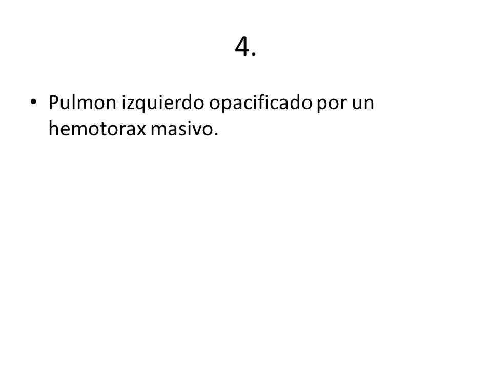 4. Pulmon izquierdo opacificado por un hemotorax masivo.