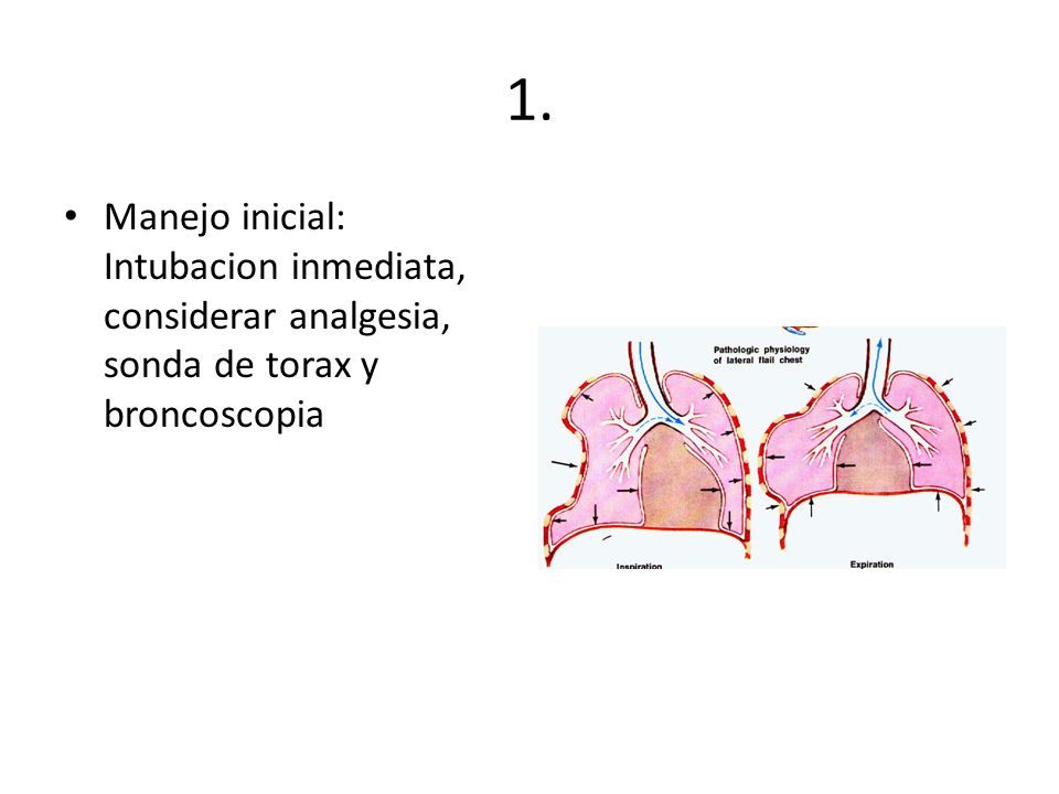1. Manejo inicial: Intubacion inmediata, considerar analgesia, sonda de torax y broncoscopia