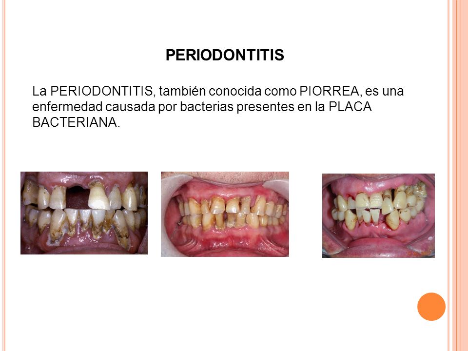 PERIODONTITIS La PERIODONTITIS, también conocida como PIORREA, es una enfermedad causada por bacterias presentes en la PLACA BACTERIANA.