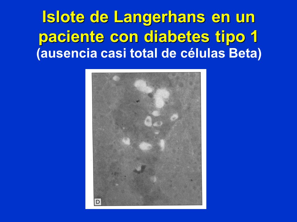 Islote de Langerhans en un paciente con diabetes tipo 1