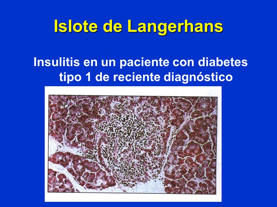 Insulitis en un paciente con diabetes tipo 1 de reciente diagnóstico