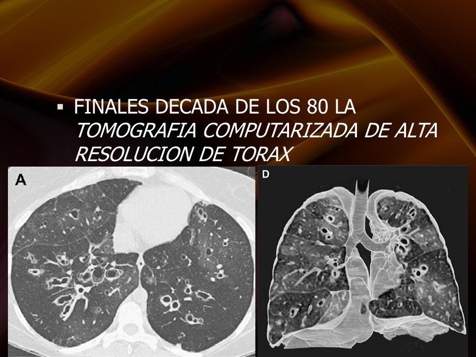 FINALES DECADA DE LOS 80 LA TOMOGRAFIA COMPUTARIZADA DE ALTA RESOLUCION DE TORAX