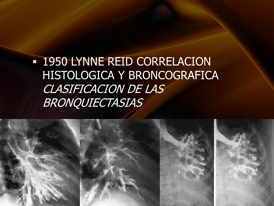 1950 LYNNE REID CORRELACION HISTOLOGICA Y BRONCOGRAFICA CLASIFICACION DE LAS BRONQUIECTASIAS