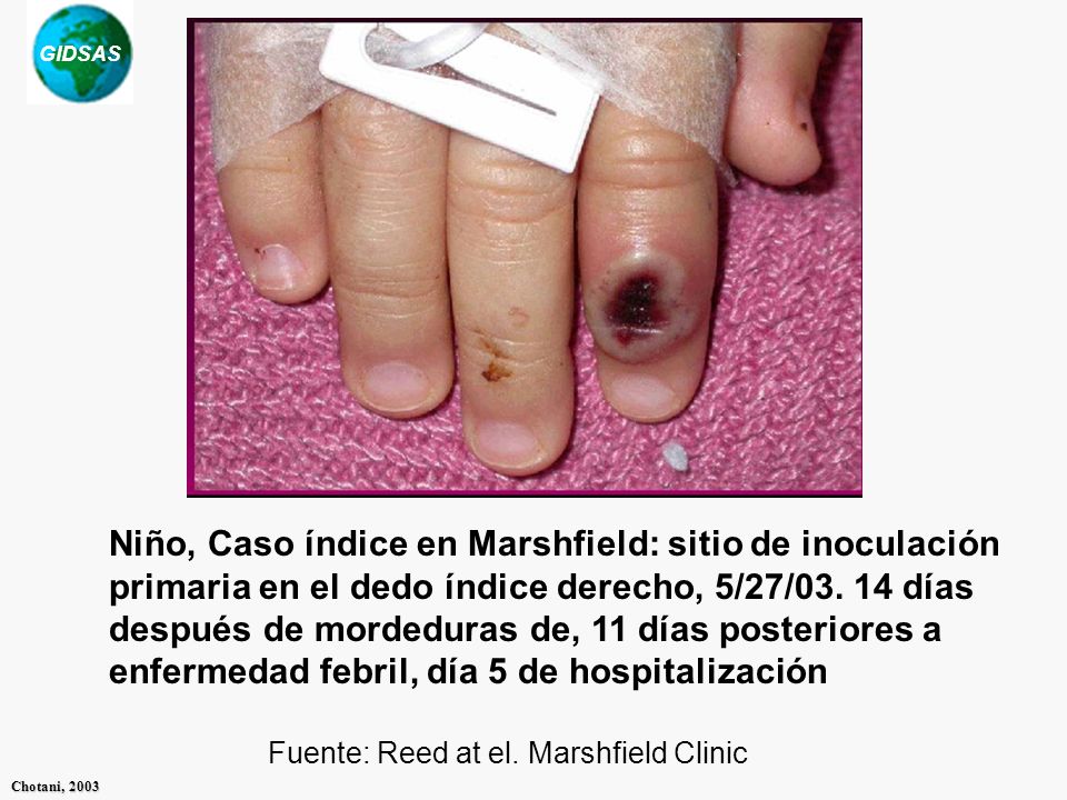 Niño, Caso índice en Marshfield: sitio de inoculación primaria en el dedo índice derecho, 5/27/ días después de mordeduras de, 11 días posteriores a enfermedad febril, día 5 de hospitalización