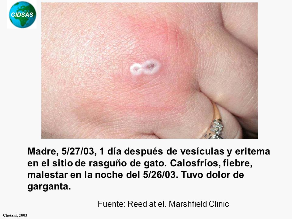 Madre, 5/27/03, 1 día después de vesículas y eritema en el sitio de rasguño de gato. Calosfríos, fiebre, malestar en la noche del 5/26/03. Tuvo dolor de garganta.