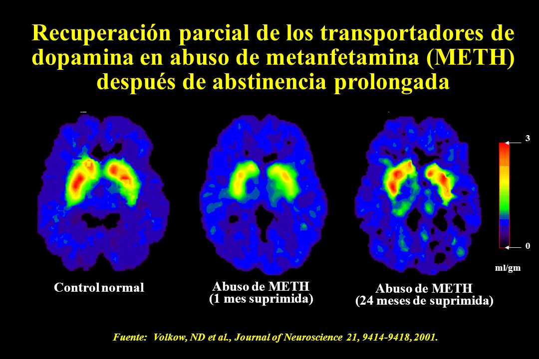 Al brain. Мрт поражение метамфетамин. After Abstinence. J Kill-Brain. Functional Neuroimaging and Recovery of function following Brain Damage in Adults..
