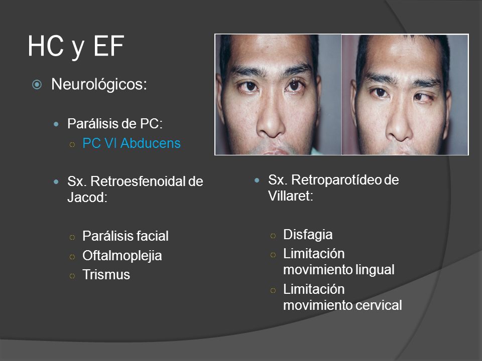 HC y EF Neurológicos: Parálisis de PC: PC VI Abducens