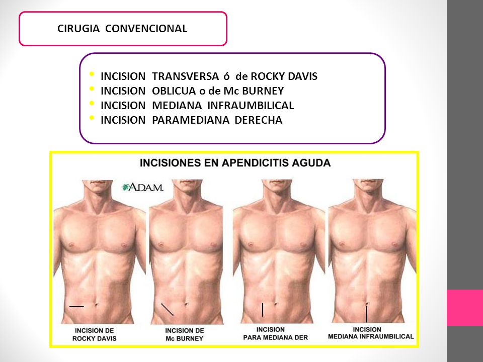 CIRUGIA CONVENCIONAL INCISION TRANSVERSA ó de ROCKY DAVIS. INCISION OBLICUA o de Mc BURNEY. INCISION MEDIANA INFRAUMBILICAL.