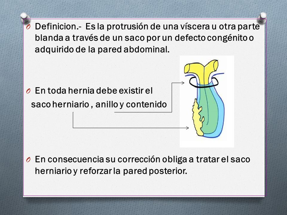 Definicion.- Es la protrusión de una víscera u otra parte blanda a través de un saco por un defecto congénito o adquirido de la pared abdominal.