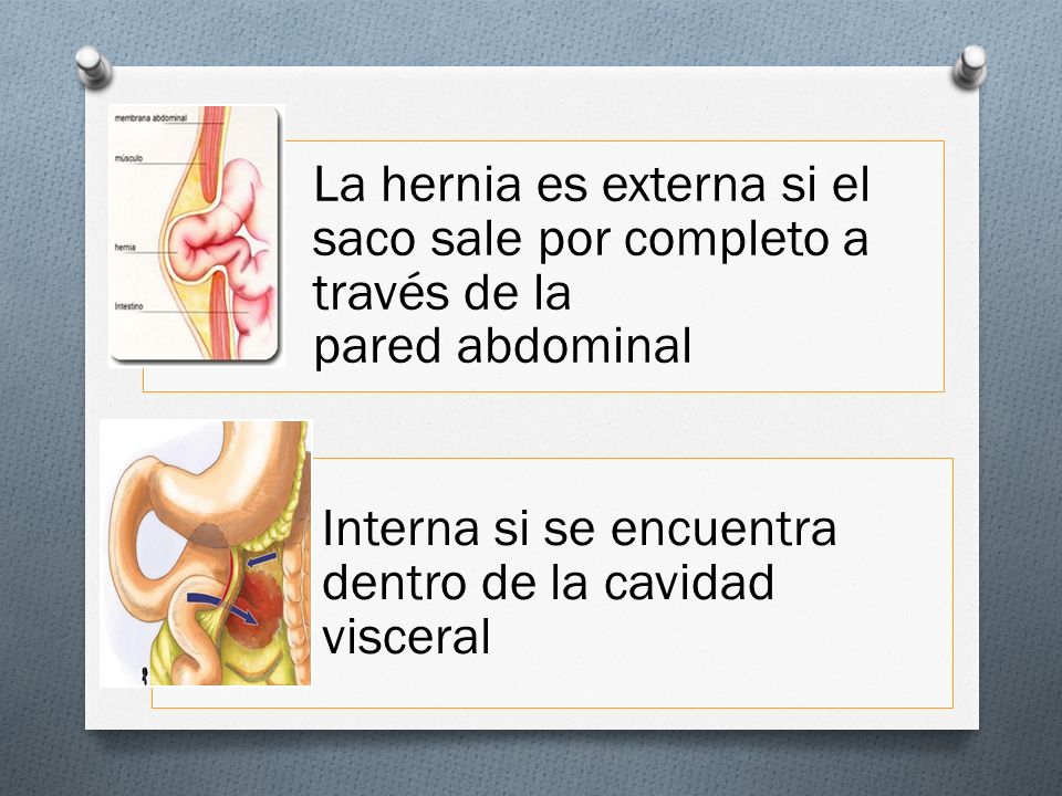 La hernia es externa si el saco sale por completo a través de la pared abdominal