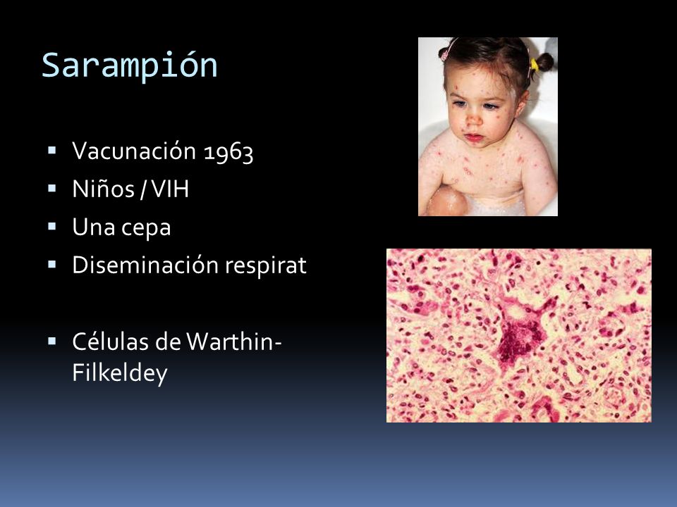 Sarampión Vacunación 1963 Niños / VIH Una cepa Diseminación respirat