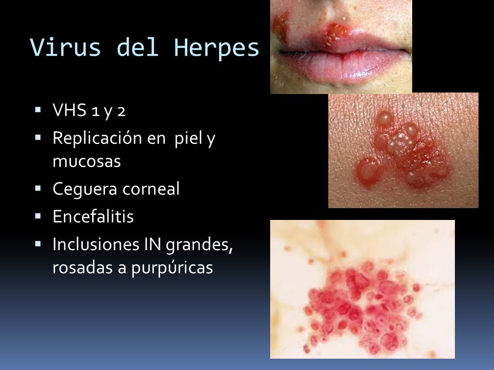 Virus del Herpes VHS 1 y 2 Replicación en piel y mucosas