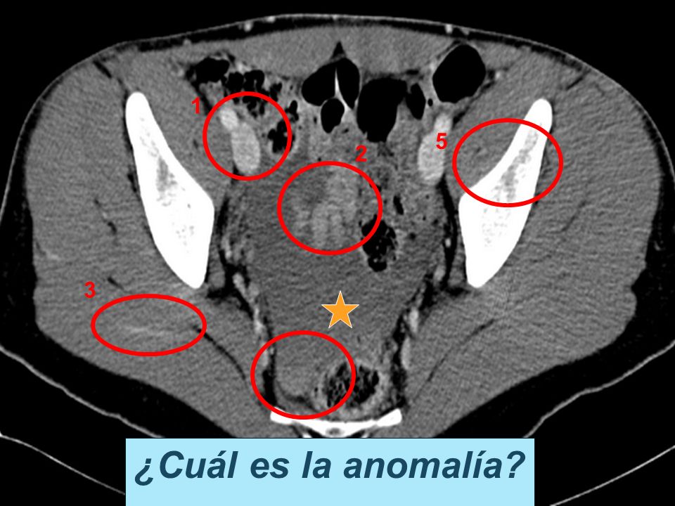 ¿ Qué clasificación de AAST de trauma tiene esta lesión más probablemente Grado I. Grado II.