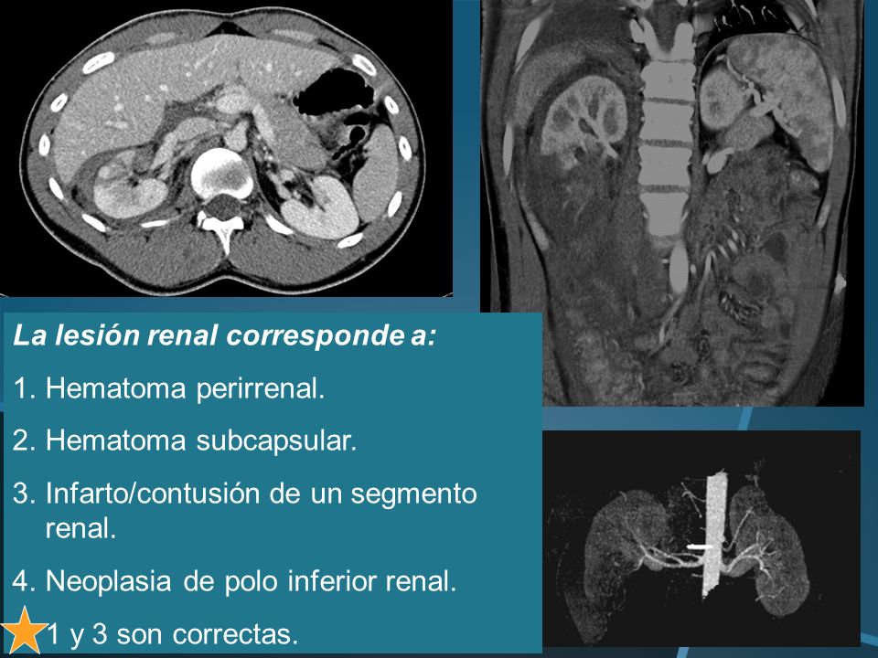 La lesión renal corresponde a: Hematoma perirrenal.