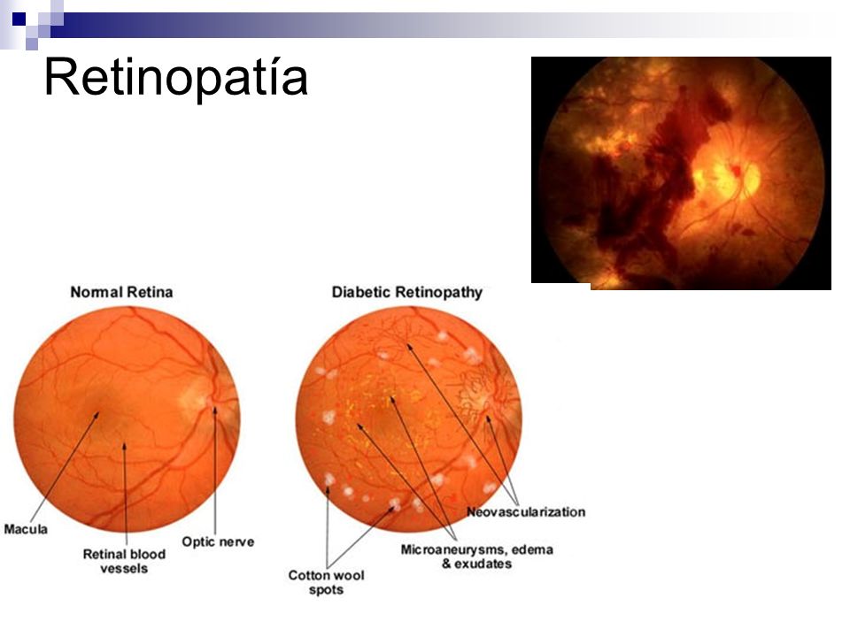 Retinopatía Signos: microaneurismas, exudados duros, exudados blandos (infarto), hemorragias.