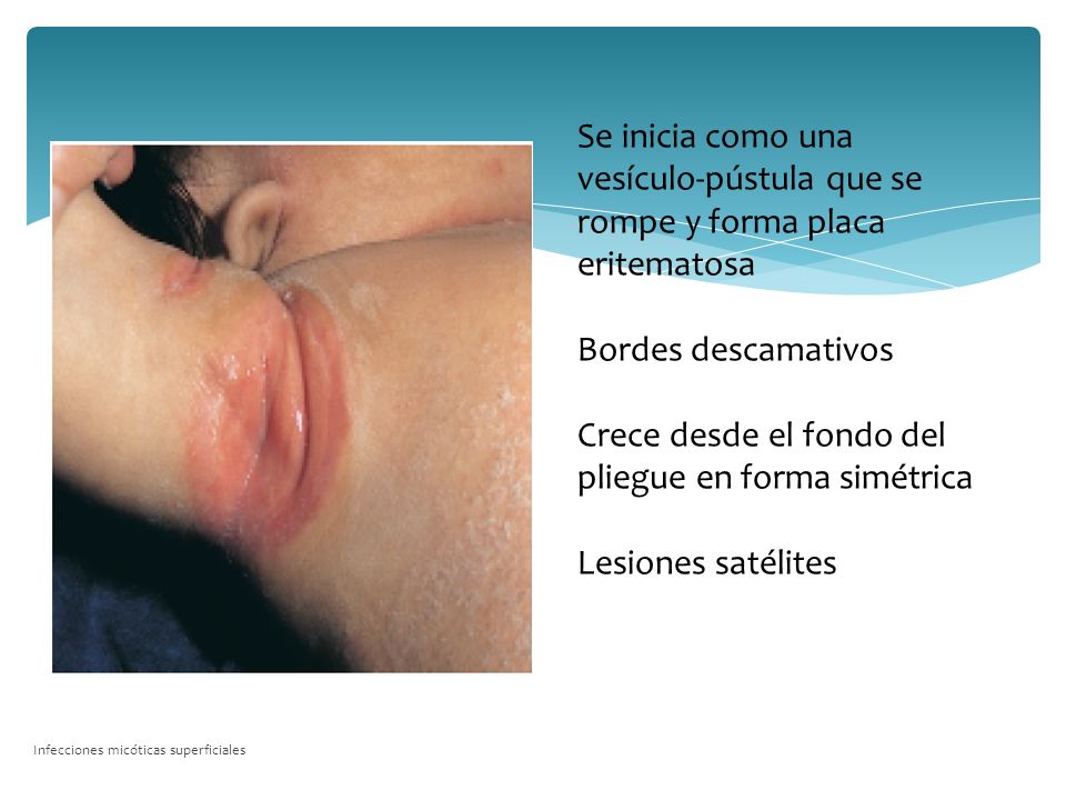 Crece desde el fondo del pliegue en forma simétrica