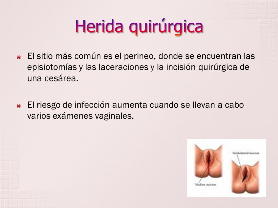 Herida quirúrgica El sitio más común es el perineo, donde se encuentran las episiotomías y las laceraciones y la incisión quirúrgica de una cesárea.