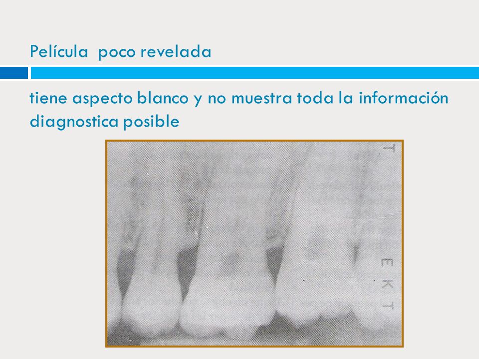 Película poco revelada tiene aspecto blanco y no muestra toda la información diagnostica posible