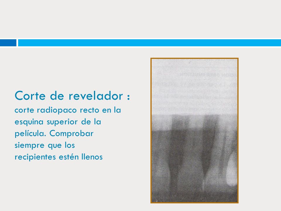 Corte de revelador : corte radiopaco recto en la esquina superior de la película.