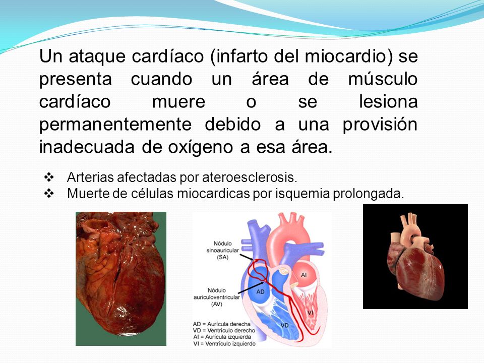 Un ataque cardíaco (infarto del miocardio) se presenta cuando un área de músculo cardíaco muere o se lesiona permanentemente debido a una provisión inadecuada de oxígeno a esa área.