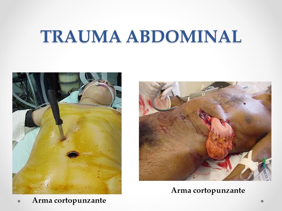 TRAUMA ABDOMINAL Arma cortopunzante Arma cortopunzante