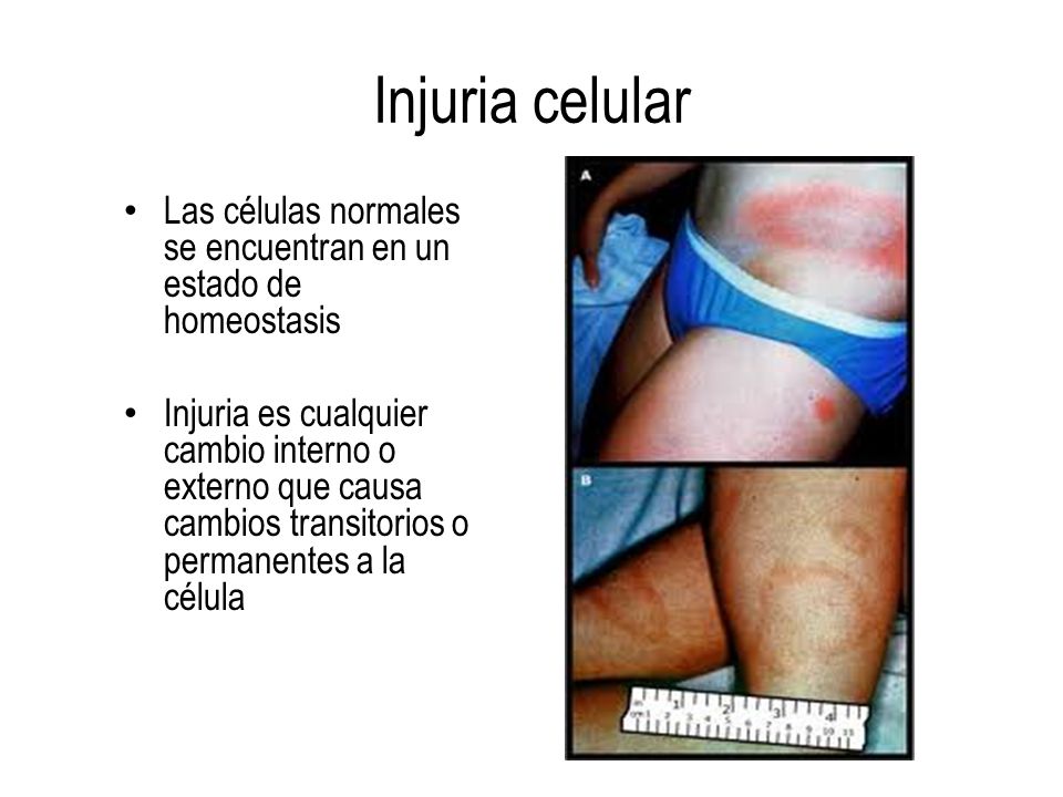 Injuria celular Las células normales se encuentran en un estado de homeostasis.