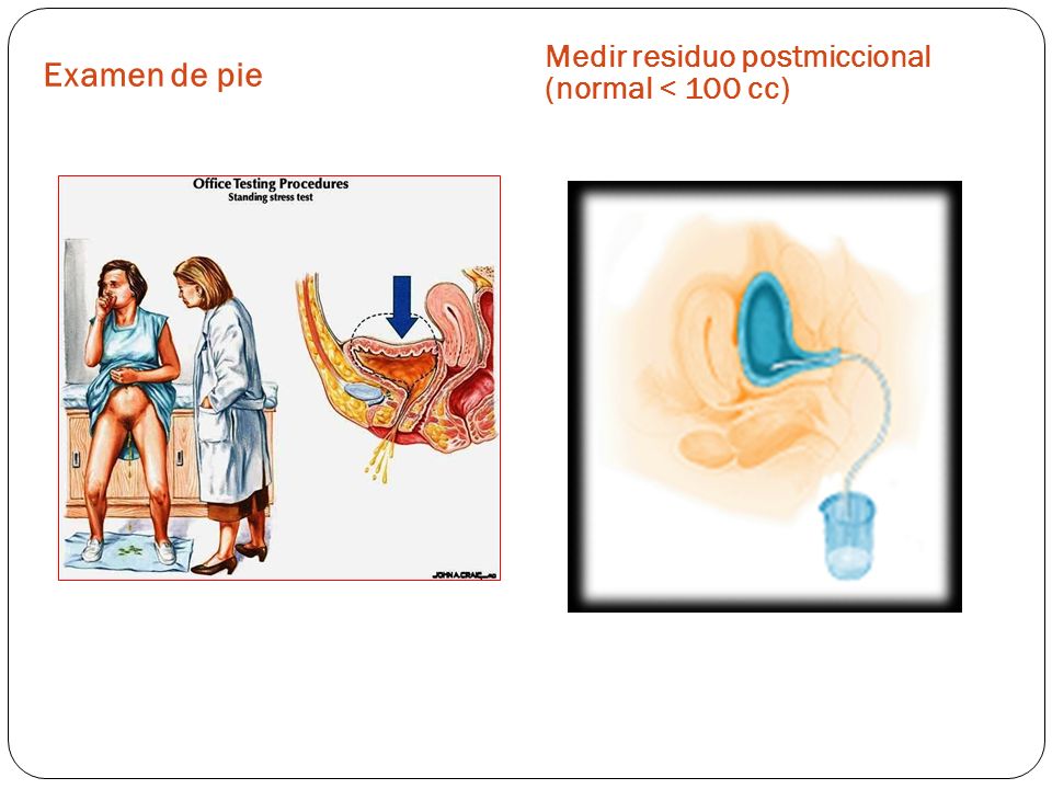 Examen de pie Medir residuo postmiccional (normal < 100 cc)
