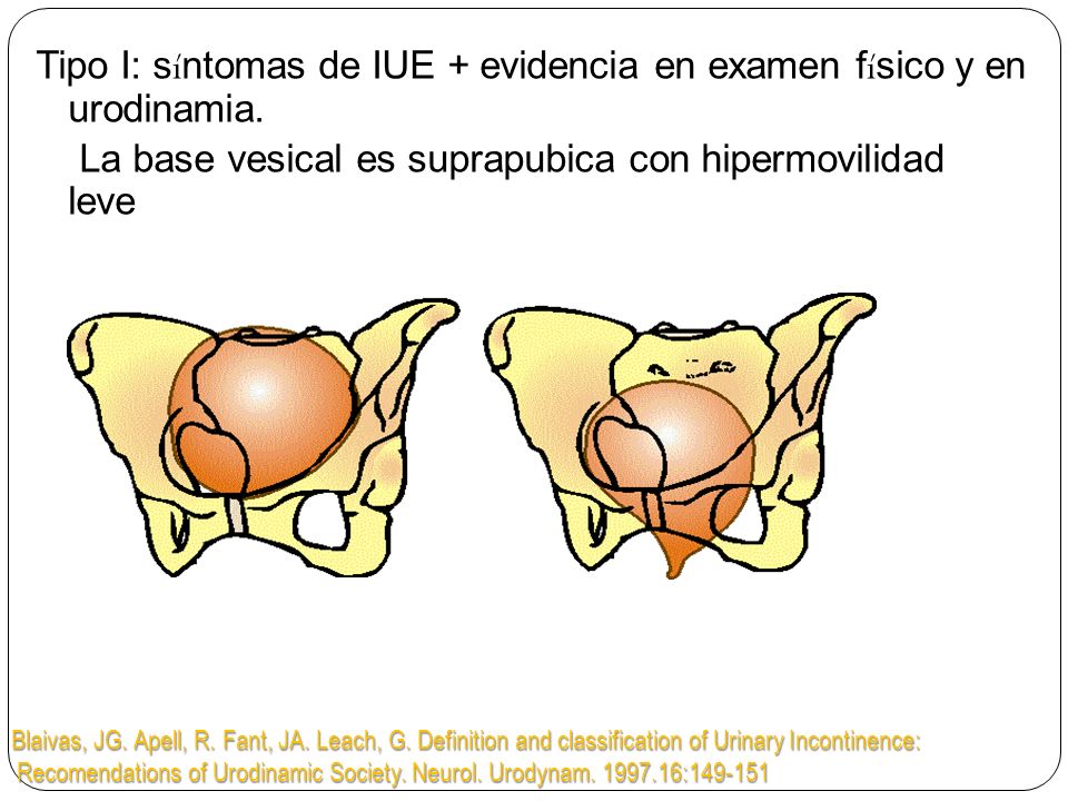 Tipo I: síntomas de IUE + evidencia en examen físico y en urodinamia.
