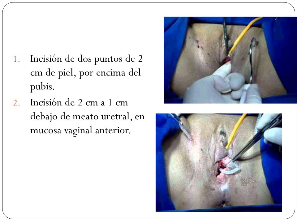 Incisión de dos puntos de 2 cm de piel, por encima del pubis.