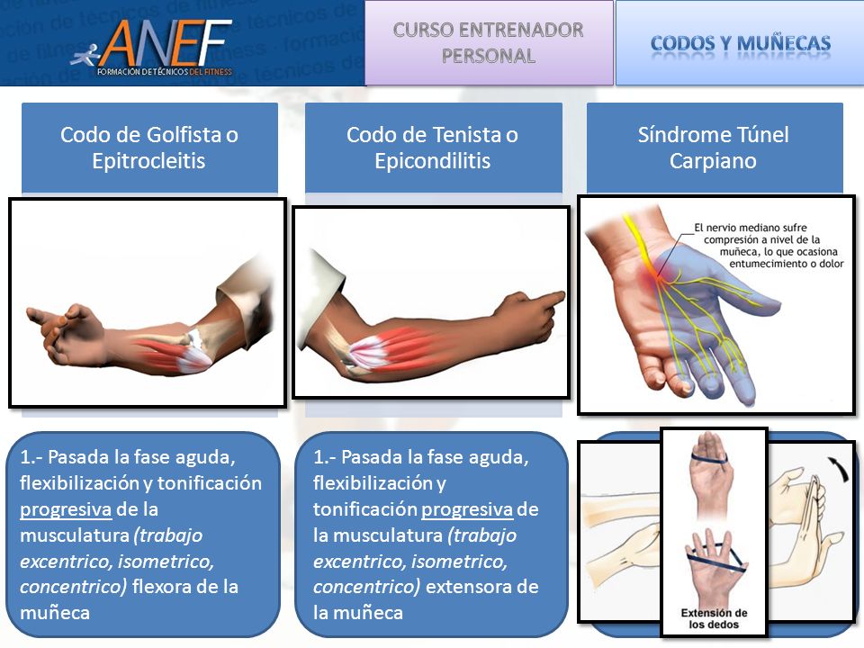 Codo de Golfista o Epitrocleitis Codo de Tenista o Epicondilitis
