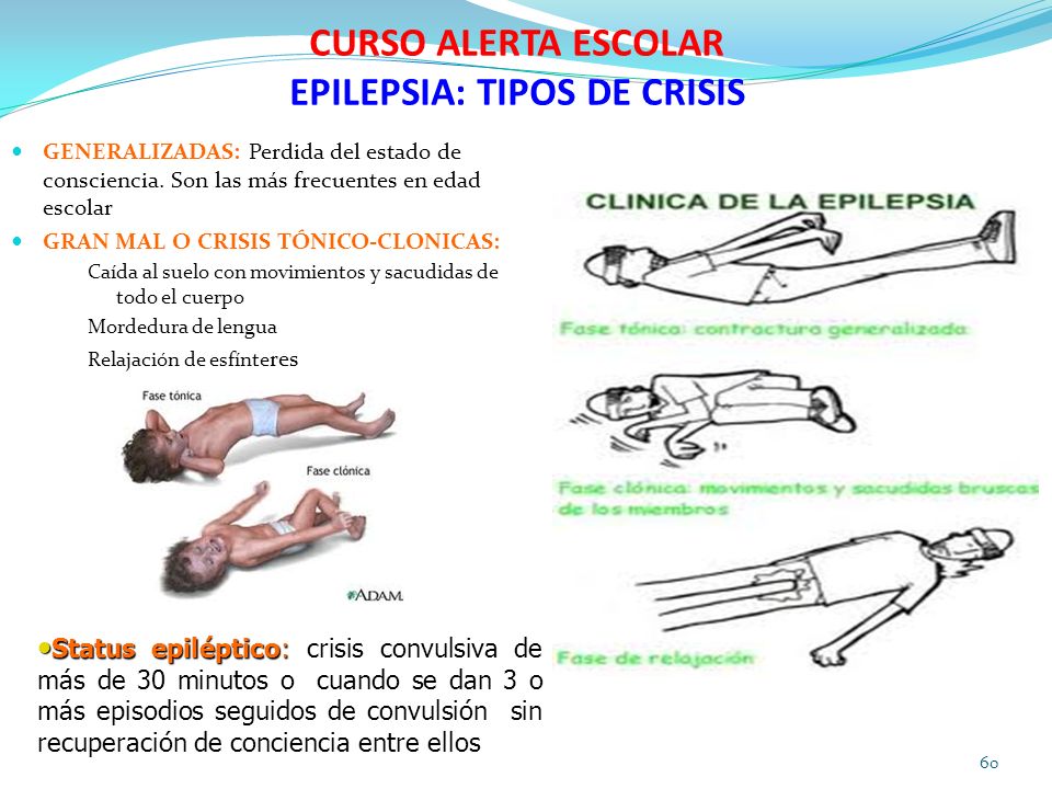 CURSO ALERTA ESCOLAR EPILEPSIA: TIPOS DE CRISIS