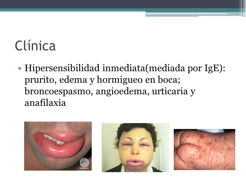 Clínica Hipersensibilidad inmediata(mediada por IgE): prurito, edema y hormigueo en boca; broncoespasmo, angioedema, urticaria y anafilaxia.