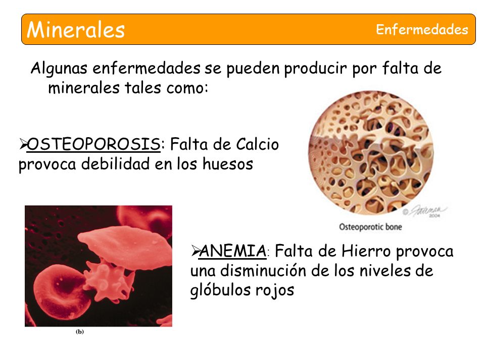 Minerales Enfermedades. Algunas enfermedades se pueden producir por falta de minerales tales como: