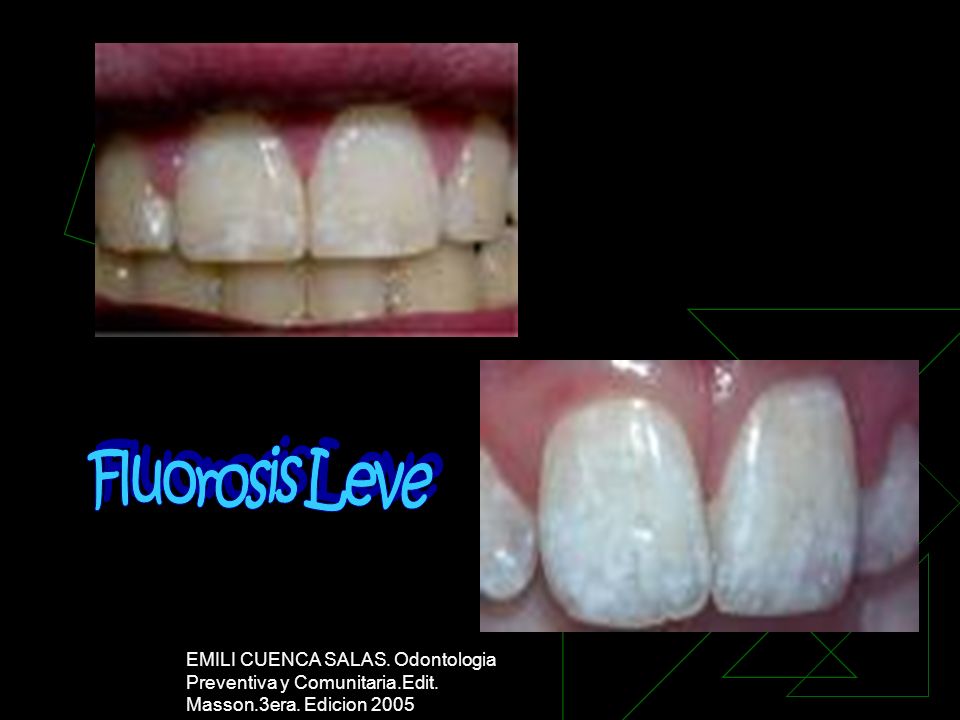 Fluorosis Leve EMILI CUENCA SALAS. Odontologia Preventiva y Comunitaria.Edit.