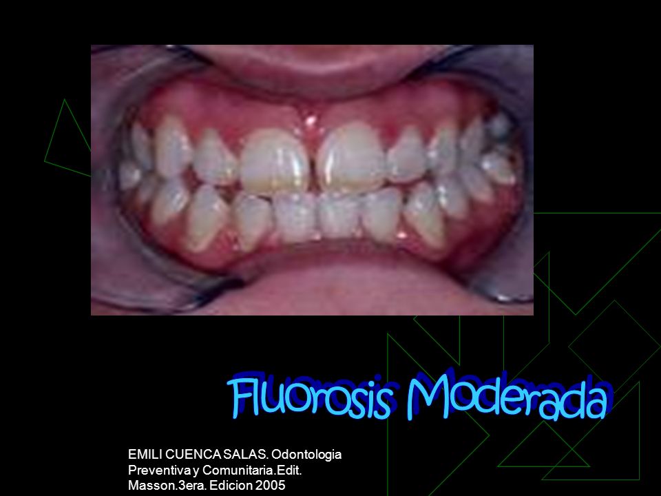 Fluorosis Moderada EMILI CUENCA SALAS. Odontologia Preventiva y Comunitaria.Edit.