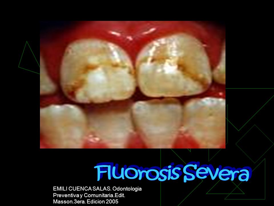Fluorosis Severa EMILI CUENCA SALAS. Odontologia Preventiva y Comunitaria.Edit.