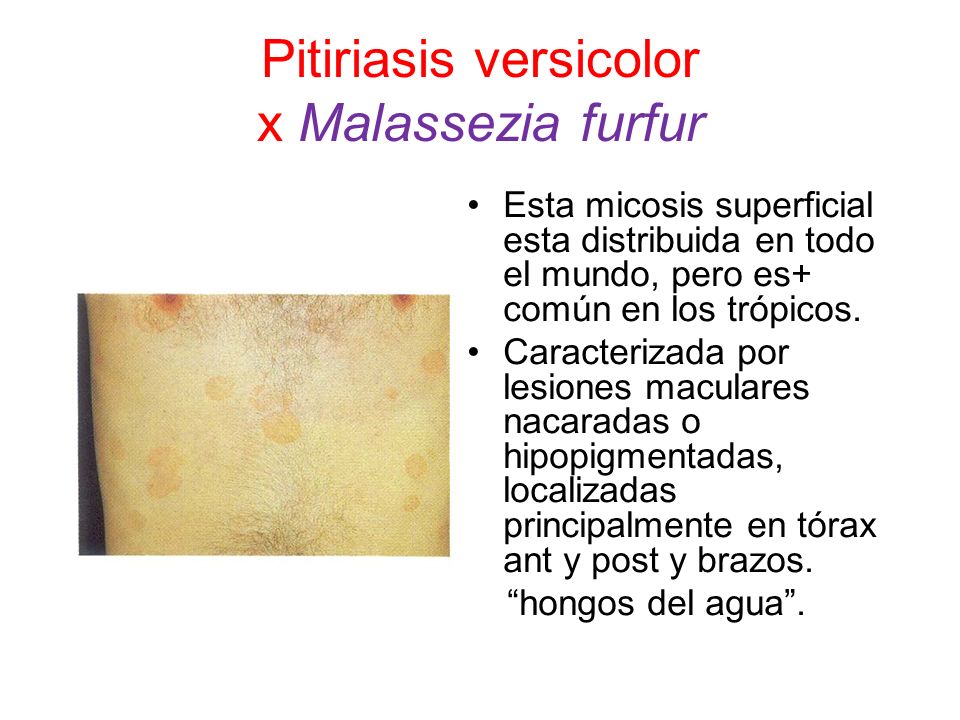 Pitiriasis versicolor x Malassezia furfur