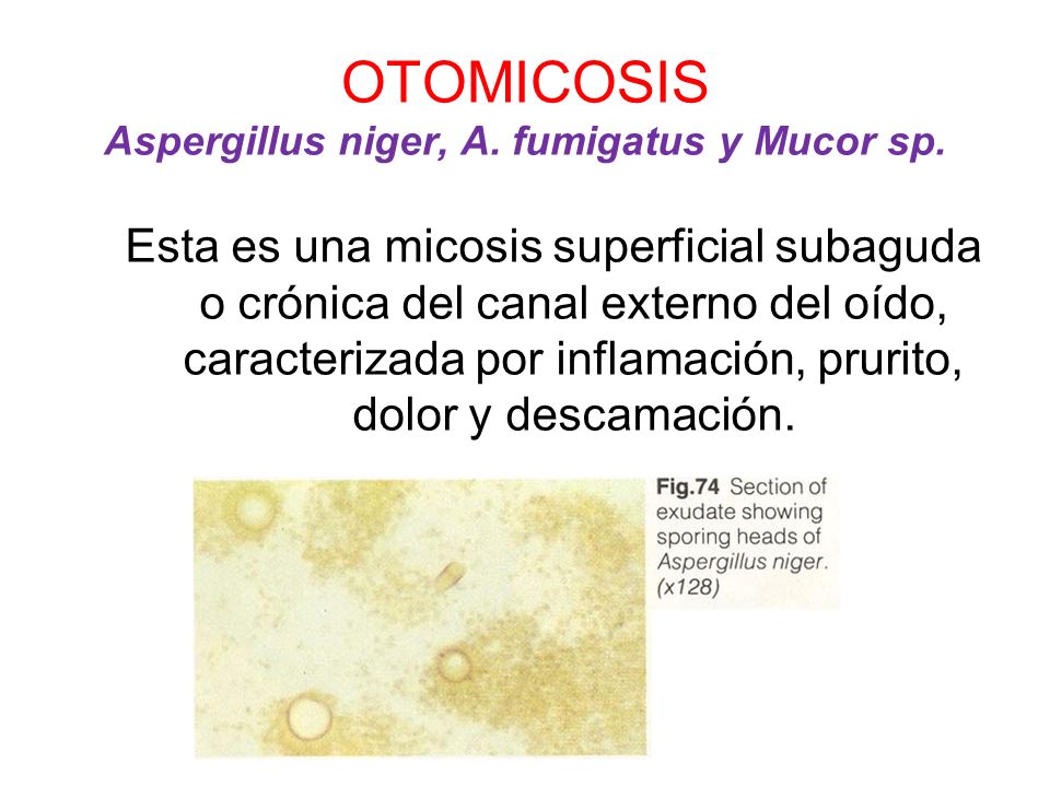 OTOMICOSIS Aspergillus niger, A. fumigatus y Mucor sp.