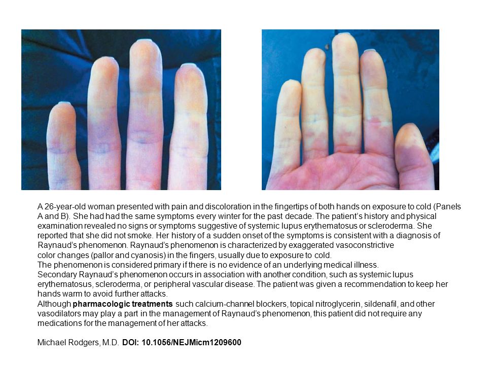 A 26-year-old woman presented with pain and discoloration in the fingertips of both hands on exposure to cold (Panels A and B). She had had the same symptoms every winter for the past decade. The patient’s history and physical examination revealed no signs or symptoms suggestive of systemic lupus erythematosus or scleroderma. She reported that she did not smoke. Her history of a sudden onset of the symptoms is consistent with a diagnosis of Raynaud’s phenomenon. Raynaud’s phenomenon is characterized by exaggerated vasoconstrictive