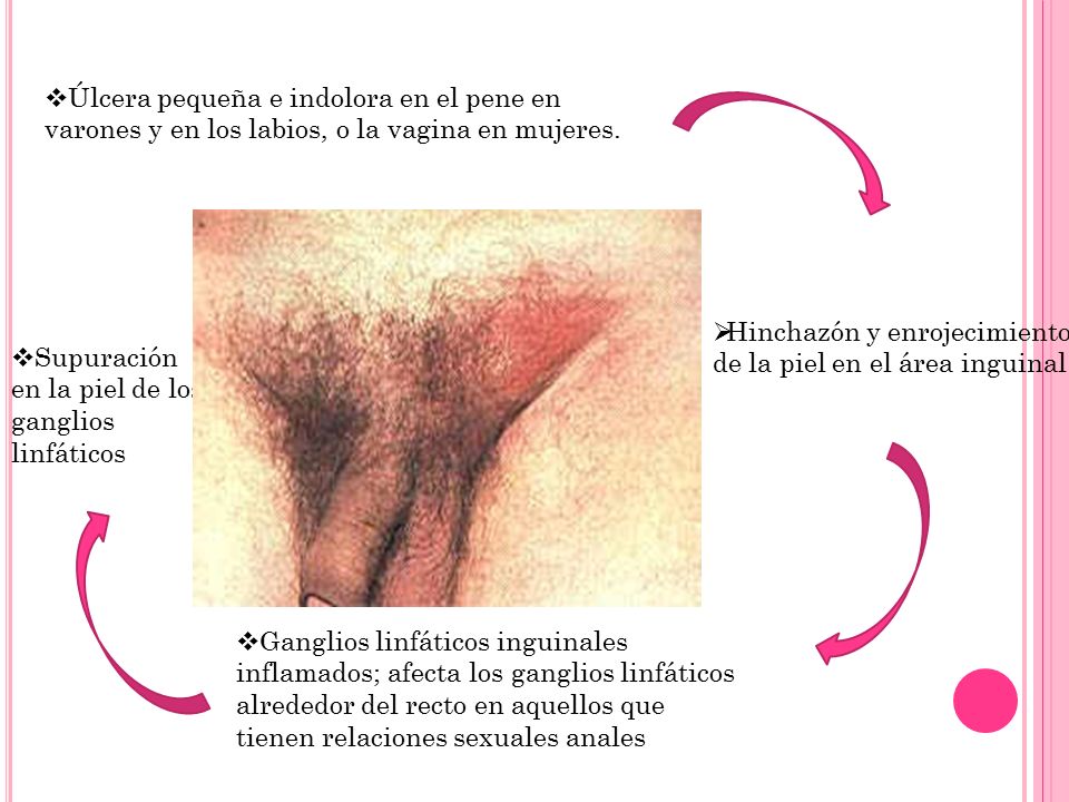 Úlcera pequeña e indolora en el pene en varones y en los labios, o la vagina en mujeres.